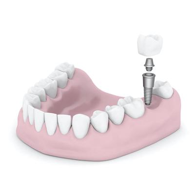 Illustration of dental implants 