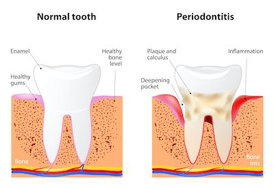 illustration of a normal tooth compared to a tooth with periodontitis