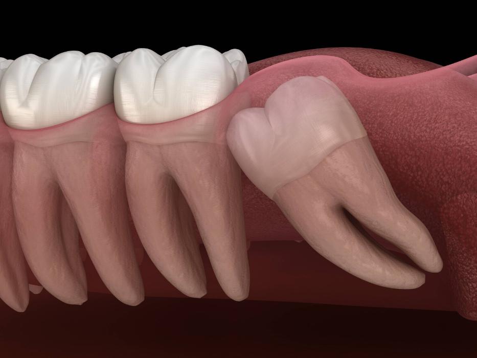 illustration of wisdom teeth