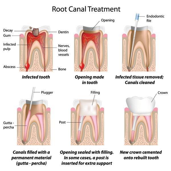 Root canal treatment illustraion