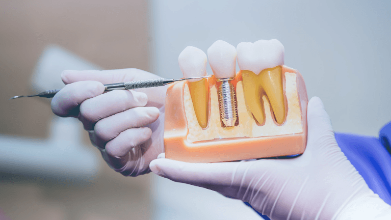 dental implant