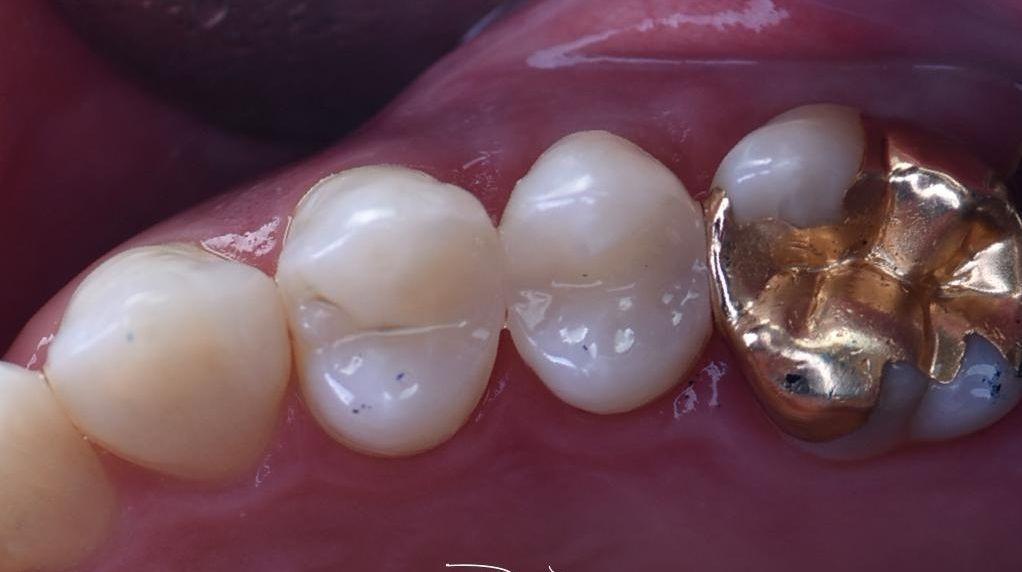 Close up of back teeth after fillings 