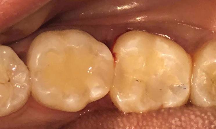 After photo of teeth with new resin composite | Dentist Barrie ON