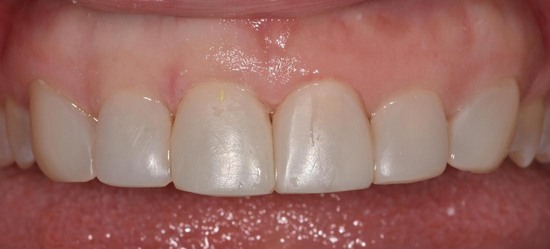 Close up of smile after veneers | Park Place Dental