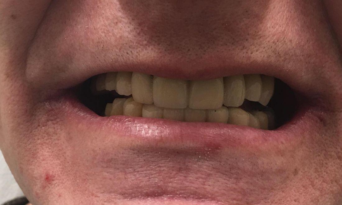 Close up of smile after dental implants | Dentist Barrie ON