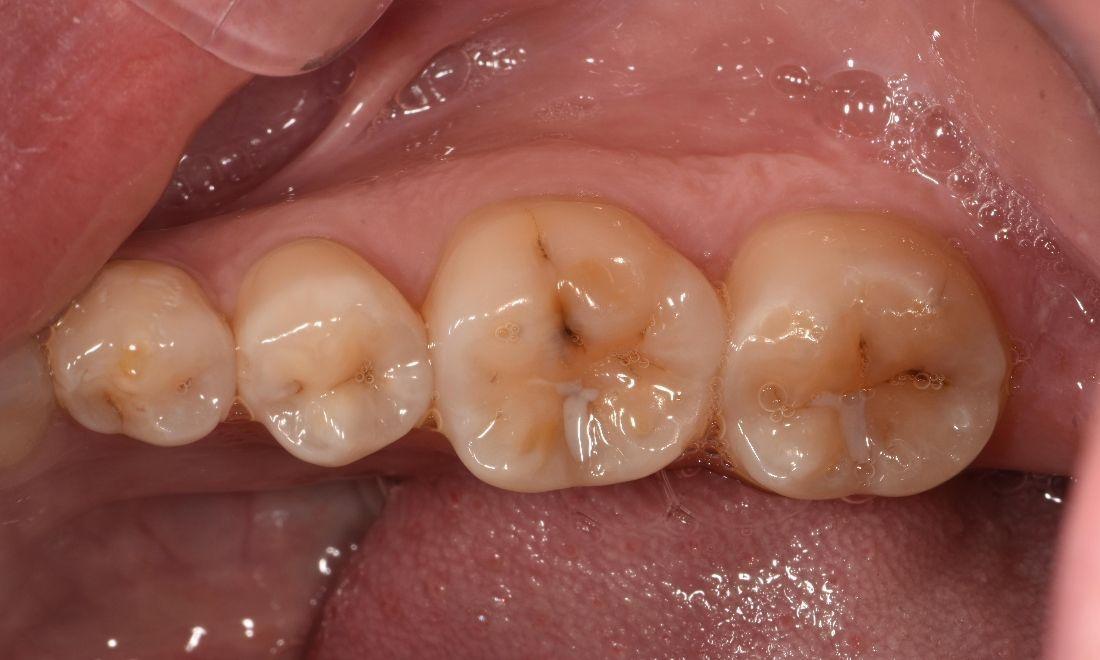 Fissure decays | Before Tooth Coloured Fillings