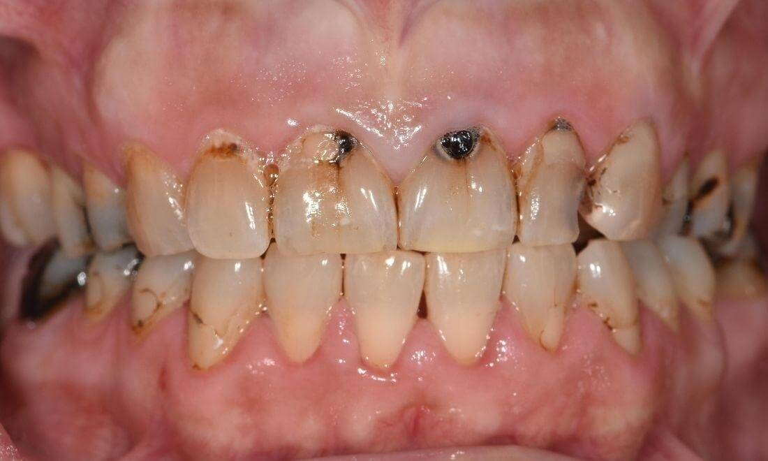 patient's teeth after dental cleaning