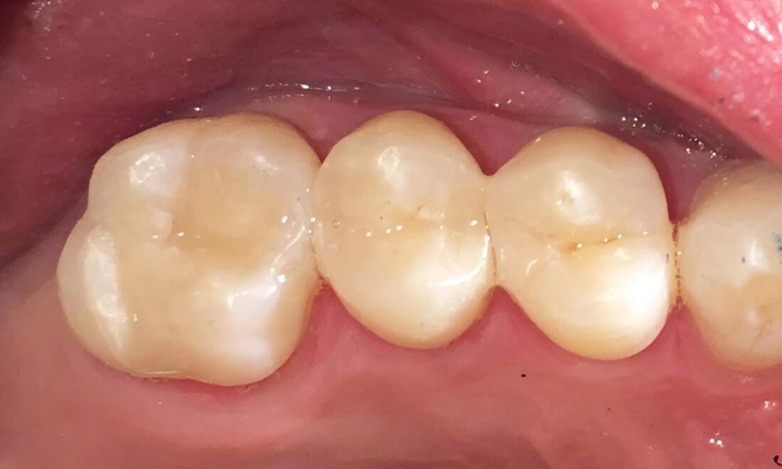 After photo of new dental filling