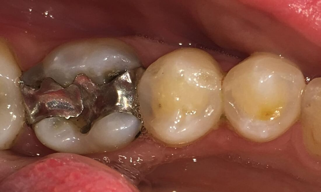 Old silver fillings before new fillings