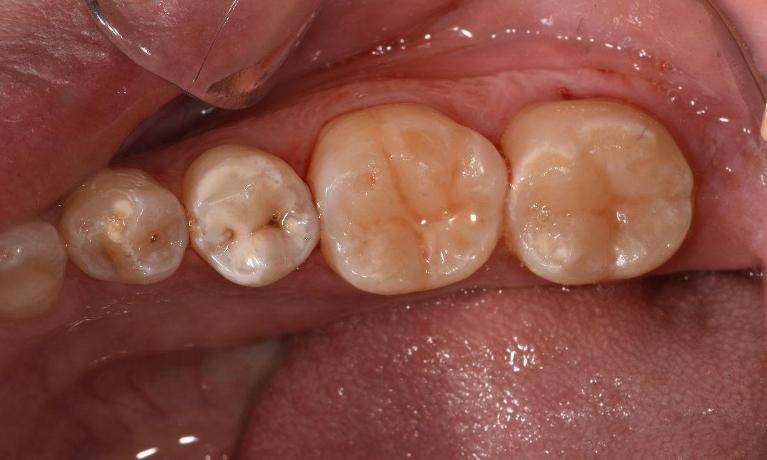 Tooth-Coloured-Fillings-After-Image