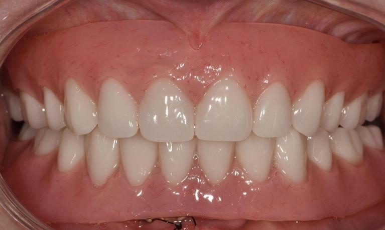 Full-Mouth-Rehabilitation-Using-Dentures-After-Image