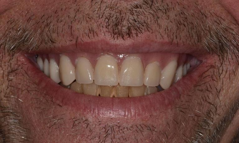 Full-Mouth-Treatment-After-Image