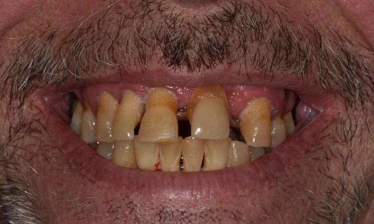 Full-Mouth-Treatment-Before-Image