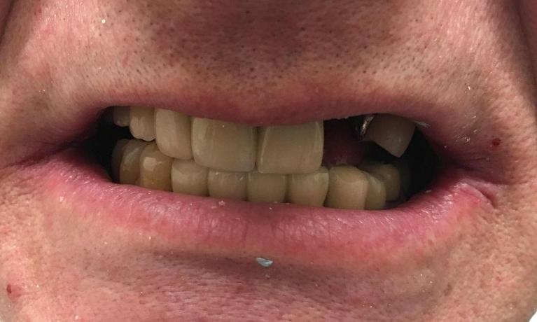 Dental-Implants-for-Missing-Teeth-Before-Image