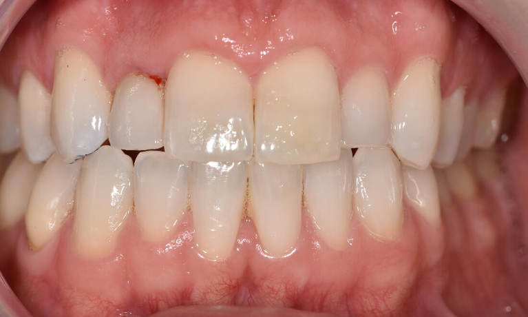 All-Ceramic-Metal-Free-Dental-Crown-After-Image