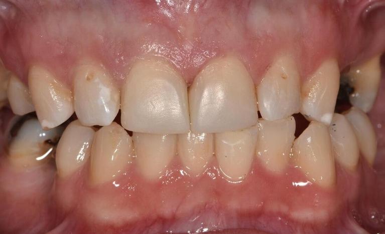 Anterior-Teeth-Restored-With-Tooth-Colour-Restorations-After-Image