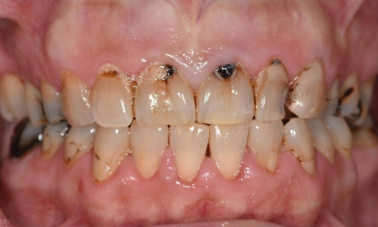 Basic-Dental-Cleaning-After-Image