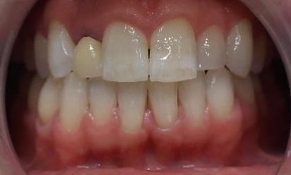 All-Ceramic-Metal-Free-Dental-Crown-Before-Image